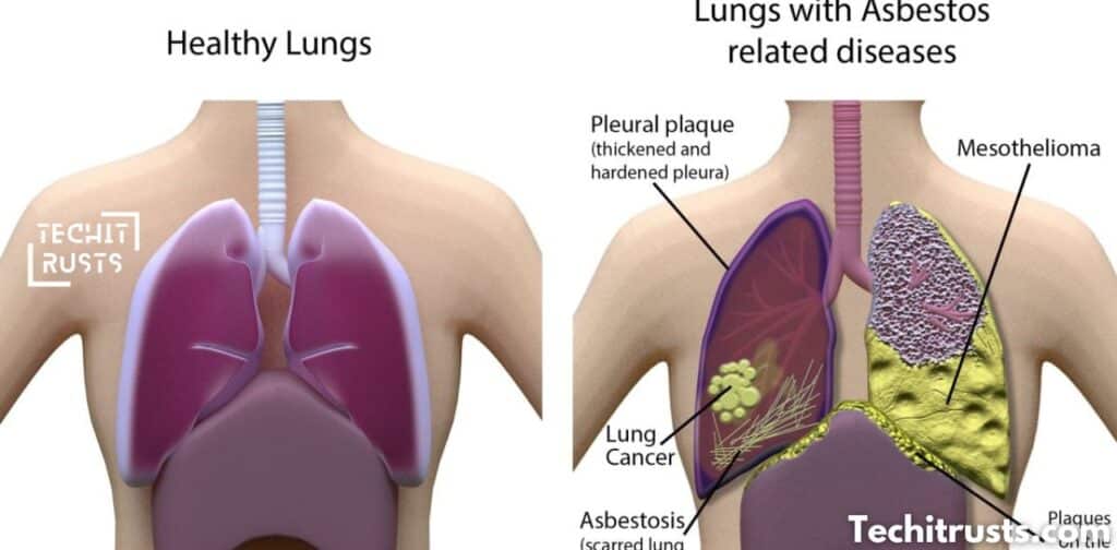 What Legal Options Are Available for Kent Residents Diagnosed with Mesothelioma or Other Asbestos-Related Diseases